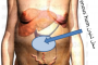 Abdominal wall collateral