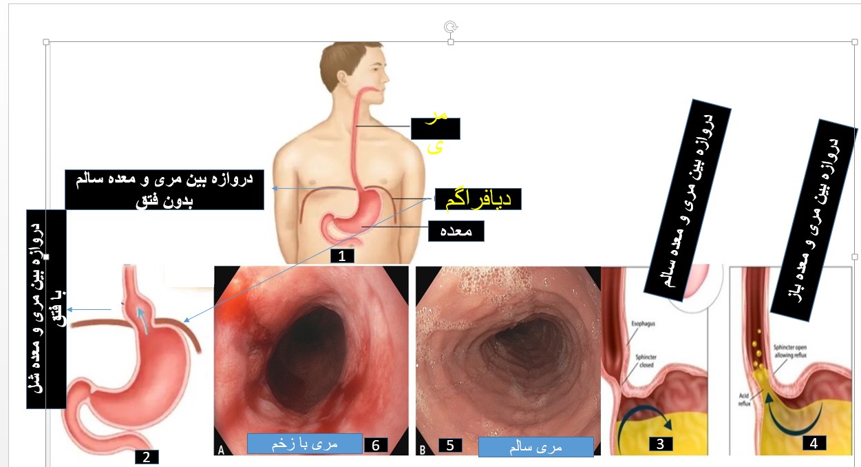 حرکت مواد غذائی از معده به مری (Gastroesophageal Reflux Disease)
